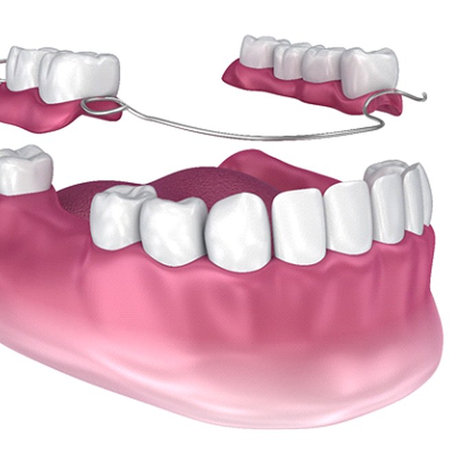partial dentures in Burien