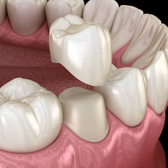 Animated dental crown restorative dentistry treatment