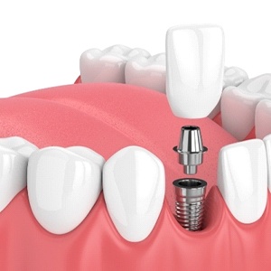 A single dental implant in Burien located in the lower arch of the mouth