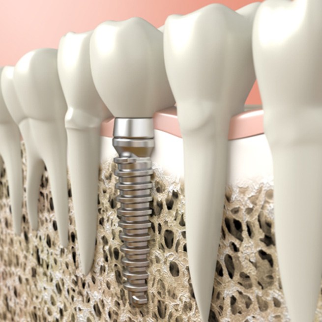 diagram of a dental implant surrounded by natural teeth 